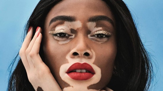 Feel Good : La mannequin Winnie Harlow pose (presque) nue et fait passer un message d'acceptation de soi (photo)