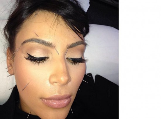 Kim Kardashian enceinte opte pour l'acupuncture, un soin à essayer ?