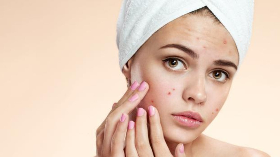 Ces 5 aliments favorisent l'apparition de boutons !